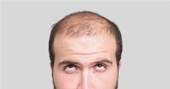FUT hair restoration procedure step by step