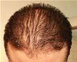 Can You Have A Hair Transplant With Diffuse Hair Loss?