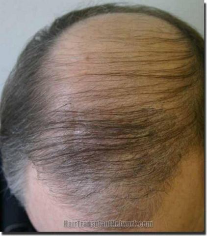 Hair Transplant Repair
