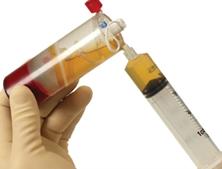 Platelet Rich Plasma Therapy For Hair Loss