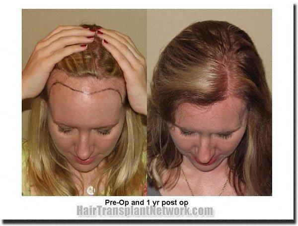 Hairline  Lowering Procedures for Women with a High Forehead