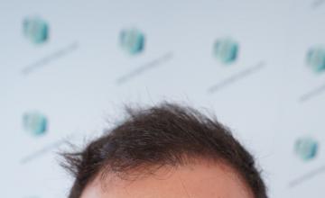 DR. Rafael de Freitas - 3589 Grafts / 9178 Hairs - FUE