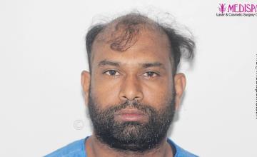 Dr. Suneet Soni - 5498 Grafts, 2 Years Result, Combine FUT + FUE + Beard   Technique, NW-VI
