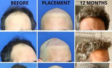 Bogota Hairlines -  2118 Grafts Dr Sergio Camacho