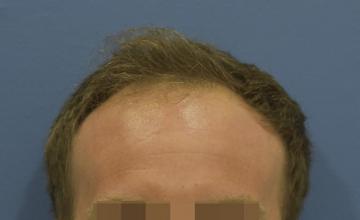 Dr. Timothy Carman- 3092 Total FU grafts; 11 month Post Op Result