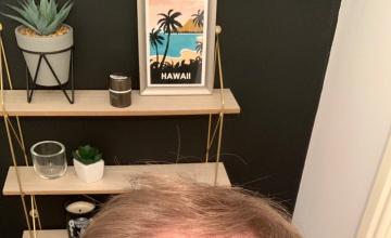Hair transplant with Dr Manish Mittal - 8 months post procedure