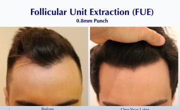 #BAM Changing a Hairline Contour (2555 FUE grafts): Carlos K. Wesley, M.D. (NYC & LA)
