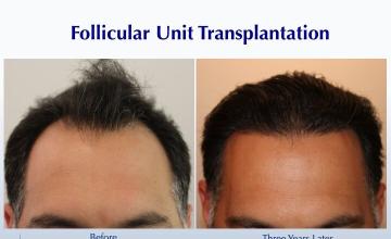 #BAM Hairline by Dr. Wesley's Team (2331 FUT grafts): Carlos K. Wesley, M.D. (NYC & LA)