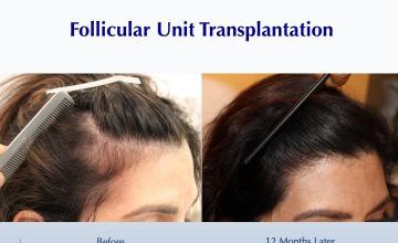 #BAM Female Hairline with Surgery and Gummy Supplement (1813 FUT grafts): Carlos K. Wesley, M.D. (NYC & LA)