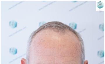 Dr. Rafael de Freitas - 2.625 Grafts - FUE + DHI