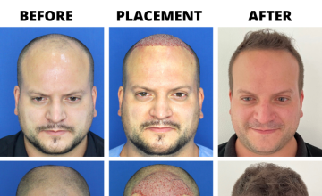 Bogota Hairlines -  1552 Grafts - Dr Sergio Camacho (Best bang for graft!)