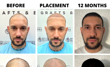 Bogota Hairlines - Dr Sergio Camacho - 3000 Grafts (Previous SMP)