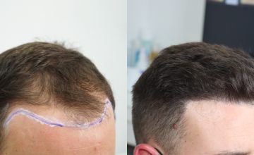 Dr. Espinosa Custodio - 4000 grafts - FUE Hair Transplant
