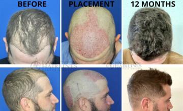 Bogota Hairlines - Dr Sergio Camacho 2415 Grafts