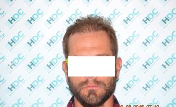 Dr. Maras at HDC clinic in Cyprus, 3000 grafts repair procedure over FUT procedure
