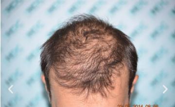 3336 grafts (400 beard grafts) repair FUE procedure by Dr. Maras and HDC medical team over previous FUT procedure