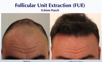 #BAM FUE to Front and Crown (5226 FUE grafts): Carlos K. Wesley, M.D. (NYC & LA)