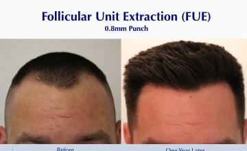 #BAM Hairline 10 Year Rewind (2396 FUE grafts): Carlos K. Wesley, M.D. (NYC & LA)