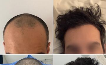 Before and After 
