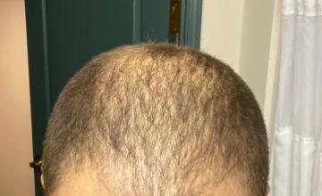 Before Hair Transplant