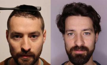 Before and after hair transplant