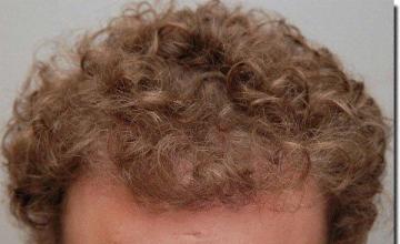 Hair restoration procedure results