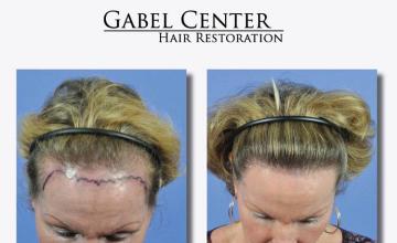 Before and after hair transplant procedure images
