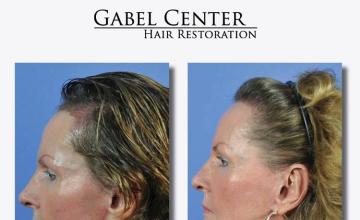 Hair restoration surgery before and after photos
