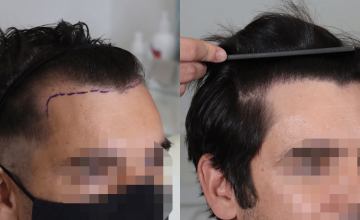 Frontal view - before and after