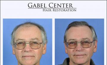 Front view - Before and after 
