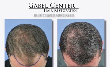 Top view before and after hair restoration results