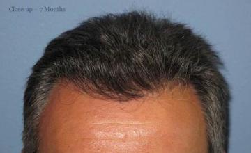 Hair restoration surgery before and after photos