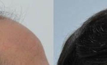 Hair restoration procedure before and after results