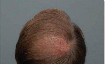 Hair restoration procedure results