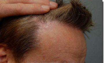 Hair restoration procedure results