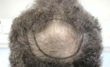 Hair restoration procedure before and after results