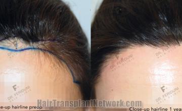 Front view - Before and after  