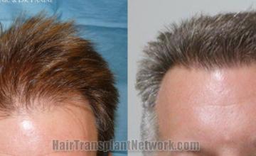 Front view - Before and after  