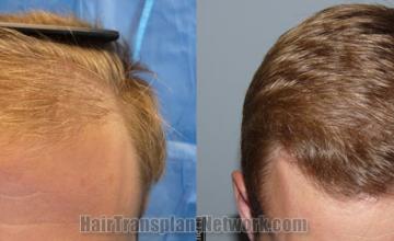 Front view - Before and after  