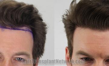 Front view - Before and after  