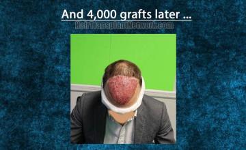 immediate postoperative hair restoration procedure images