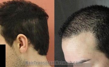 Hair transplantation surgery before and after images