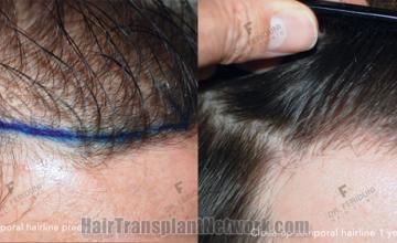 Hair transplantation surgery before and after images