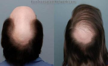 Back view before and after hair transplant