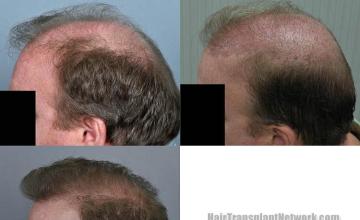 Hair transplantation surgery before and after pictures