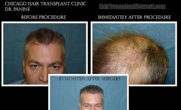 Hair restoration procedure before and after results