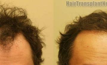 Front view - Before and after  