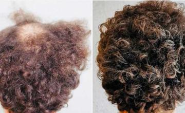 Before after FUE 4300 grafts, back of head