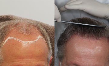 Frontal before and after hair transplant