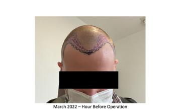 2,219 Grafts FUE Hairline